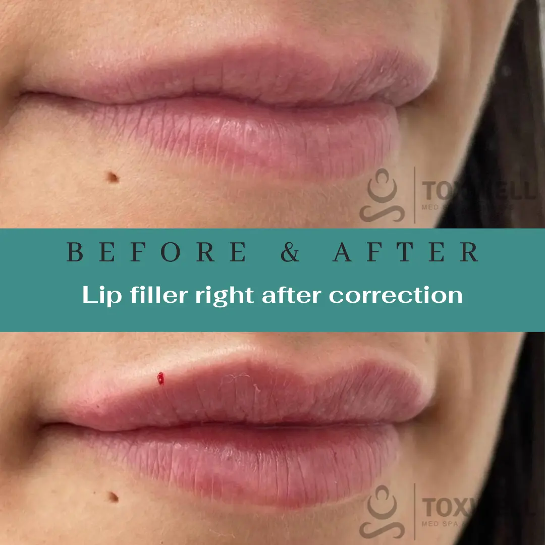 Dermal Filler