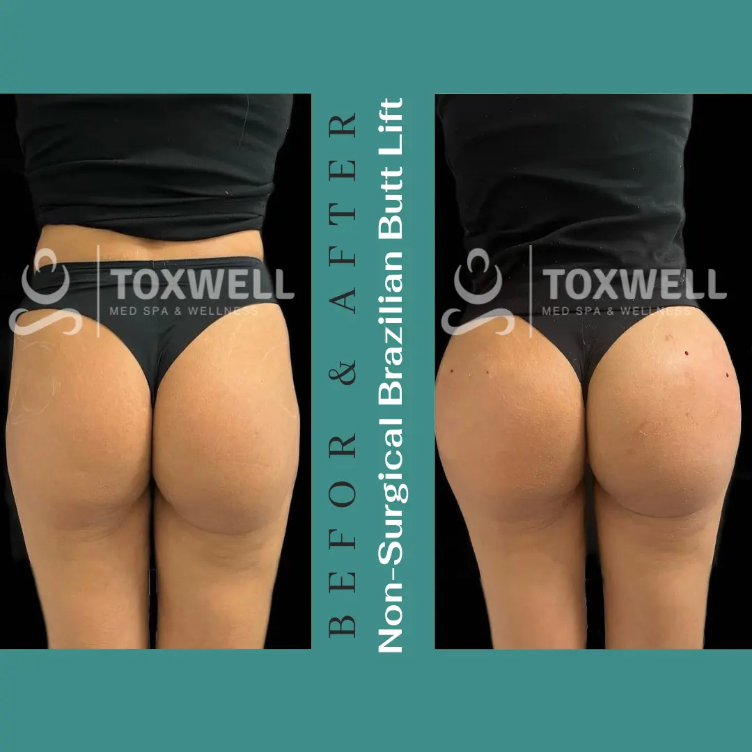 The image features a side-by-side comparison of a woman's lower body in a "before and after" format for a LIQUID NON-SURGICAL BRAZILIAN BUTT LIFT (BBL). She is wearing pink underwear, and the noticeable change is the lift and enhanced shape of her buttocks. The "after" side shows a more contoured and lifted appearance.