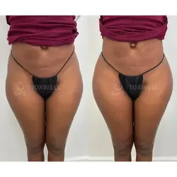 Side-by-side comparison of a woman's lower back and buttocks, possibly after a liquid BBL in Miami.