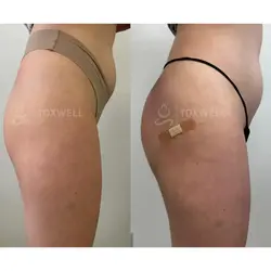 sculptra_liquid_bbl_non-surgical_brazilian_butt_lift