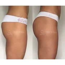 sculptra_liquid_bbl_non-surgical_brazilian_butt_lift