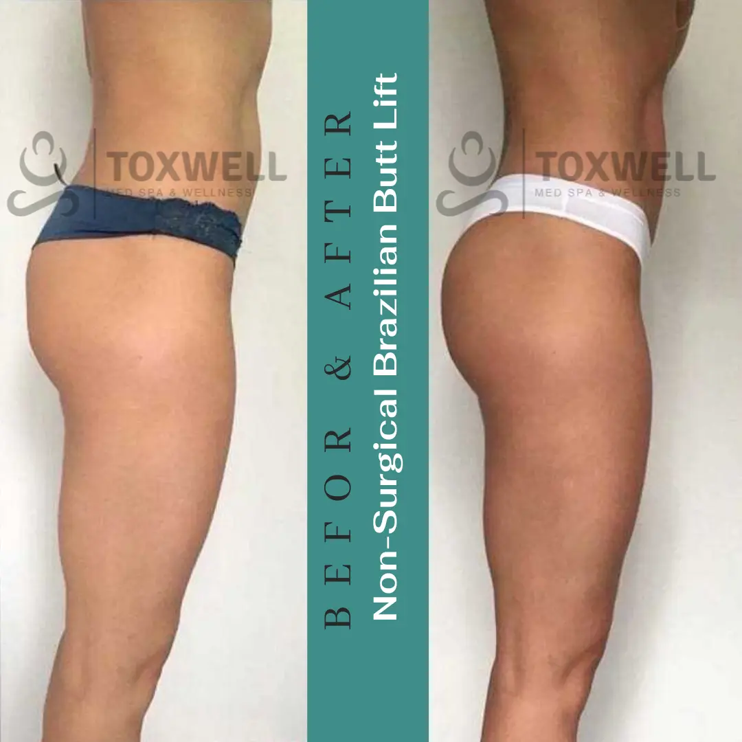 The image features a side-by-side comparison of a woman's lower body in a "before and after" format for a LIQUID NON-SURGICAL BRAZILIAN BUTT LIFT (BBL). She is wearing pink underwear, and the noticeable change is the lift and enhanced shape of her buttocks. The "after" side shows a more contoured and lifted appearance.