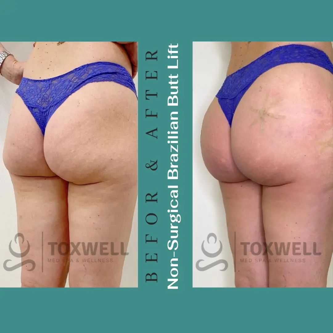 The image features a side-by-side comparison of a woman's lower body in a "before and after" format for a LIQUID NON-SURGICAL BRAZILIAN BUTT LIFT (BBL). She is wearing pink underwear, and the noticeable change is the lift and enhanced shape of her buttocks. The "after" side shows a more contoured and lifted appearance.