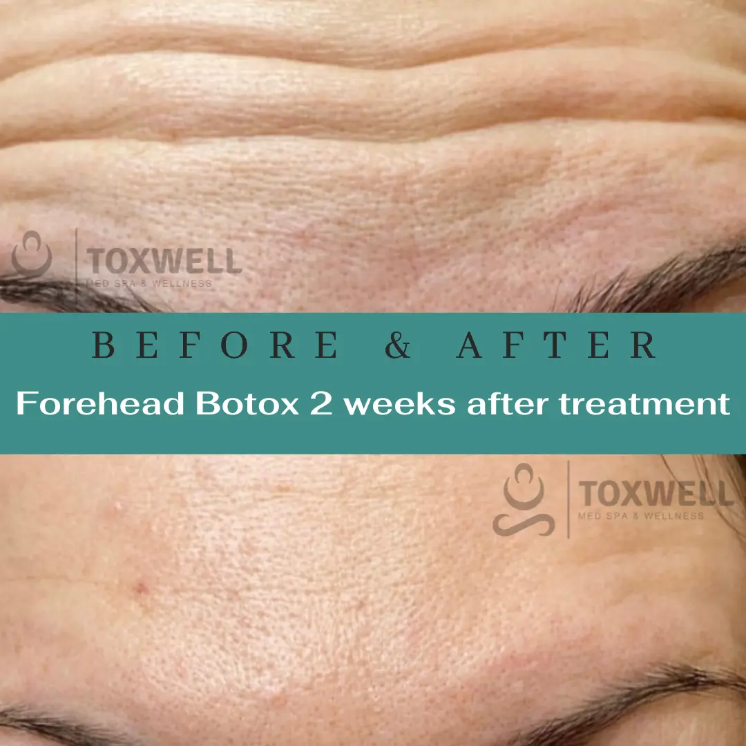 Botox injections