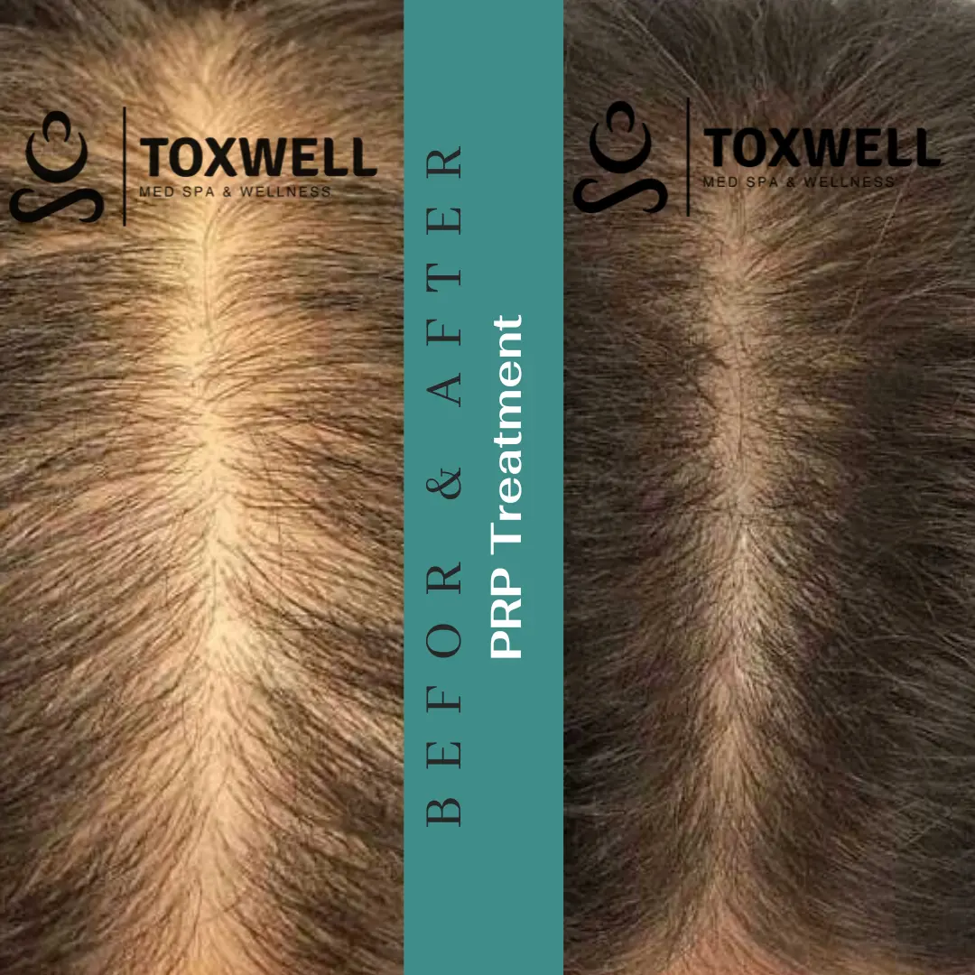 PRP Hair Loss Treatment