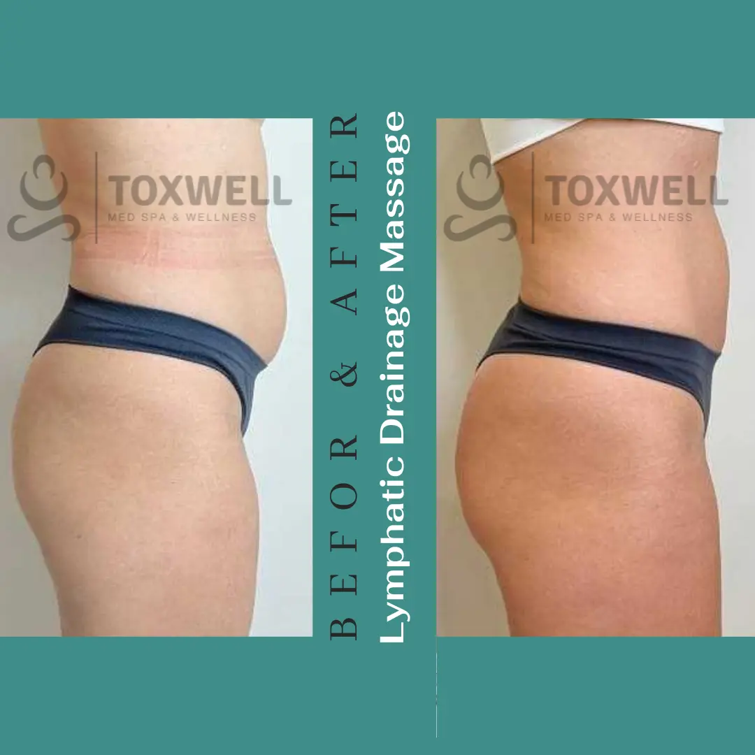 Body contouring