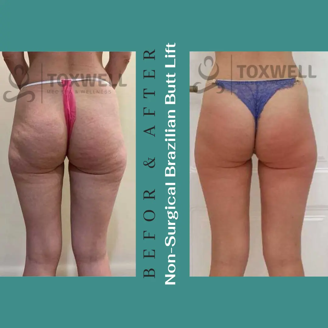 The image features a side-by-side comparison of a woman's lower body in a "before and after" format for a LIQUID NON-SURGICAL BRAZILIAN BUTT LIFT (BBL). She is wearing pink underwear, and the noticeable change is the lift and enhanced shape of her buttocks. The "after" side shows a more contoured and lifted appearance.