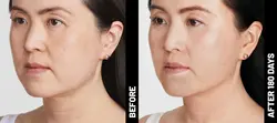 Ultherapy: Non-Invasive Skin Tightening & Lifting Treatment