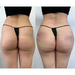 Side-by-side comparison of a woman's lower back and buttocks, possibly after a liquid BBL in Miami. 