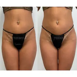 Side-by-side comparison of a woman's lower back and buttocks, possibly after a liquid BBL in Miami. 