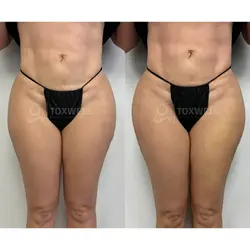 Side-by-side comparison of a woman's lower back and buttocks, possibly after a liquid BBL in Miami. 