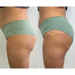 Side-by-side comparison of a woman's lower back and buttocks, possibly after a liquid BBL in Miami. 