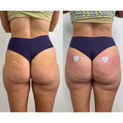 Side-by-side comparison of a woman's lower back and buttocks, possibly after a liquid BBL in Miami. 