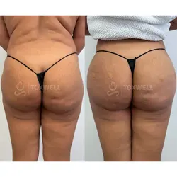 Side-by-side comparison of a woman's lower back and buttocks, possibly after a liquid BBL in Miami. 