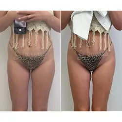 Side-by-side comparison of a woman's lower back and buttocks, possibly after a liquid BBL in Miami.