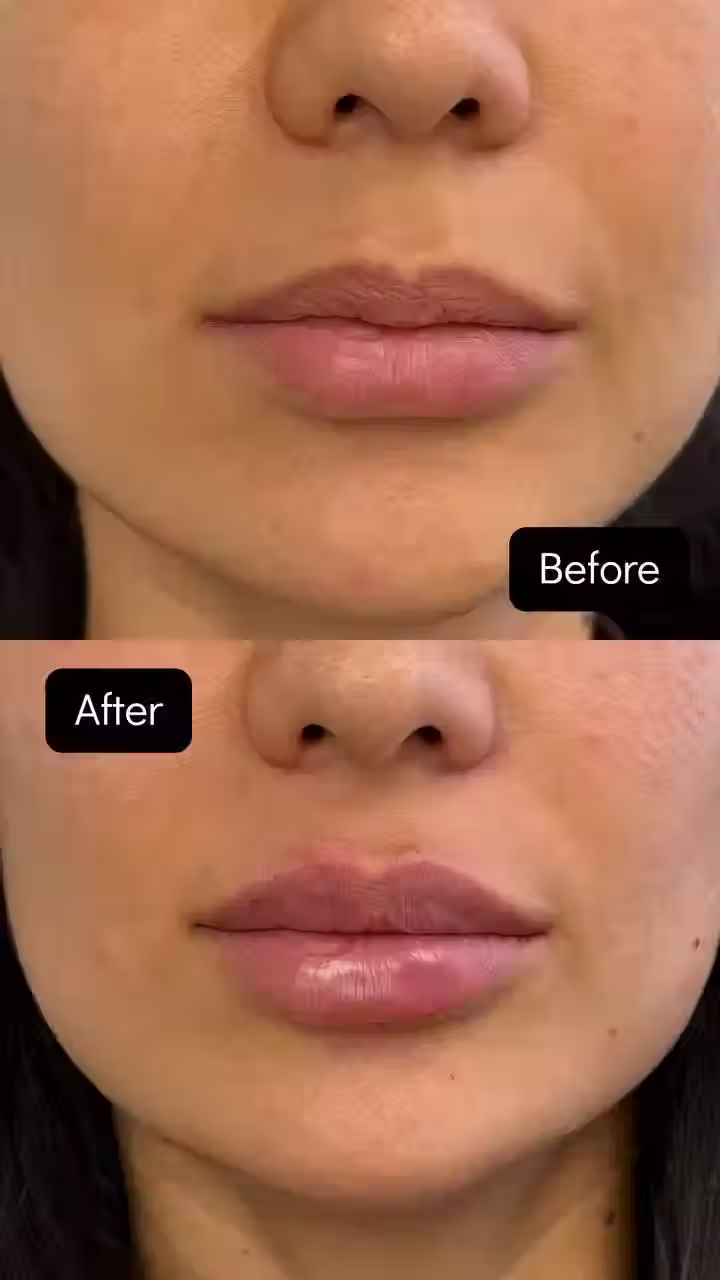 Close-up photo of a woman’s lower face, showing her lips and chin. The top image, labeled "Before," shows natural lips. The bottom "After" image shows fuller lips after a lip filler treatment in Hallandale.