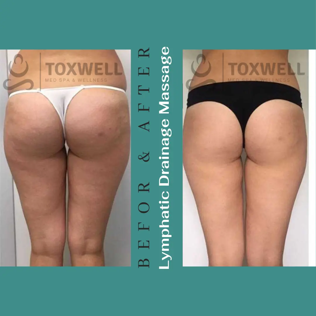 Body contouring