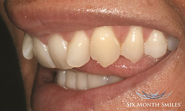 Before Six Month Smiles - College Street Smiles