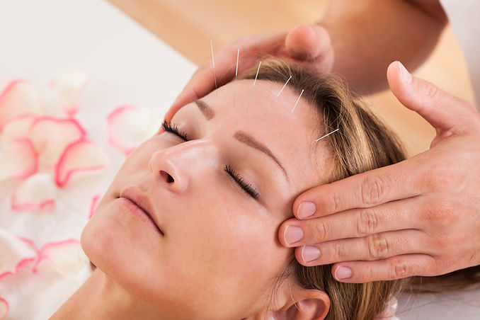 a woman is having cosmetic acupuncture treatment