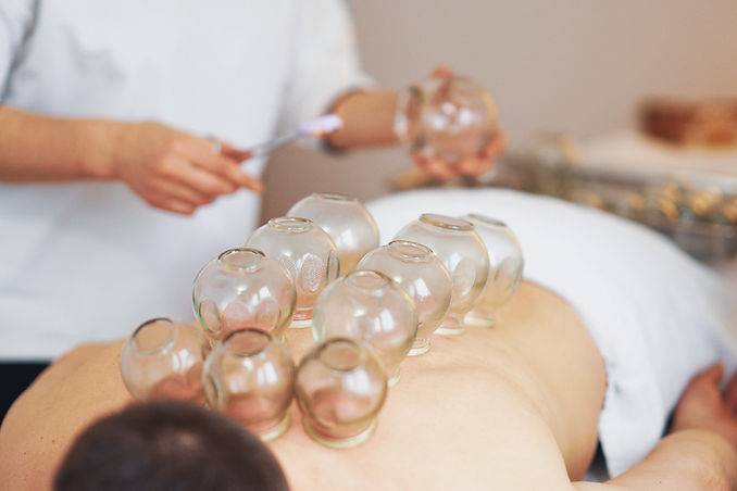a patient is having fire cupping treatment on the back.