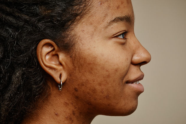 profile-ethnic-young-woman-smiling-with-acne-scars-2025-03-07-22-45-06-utc.jpg