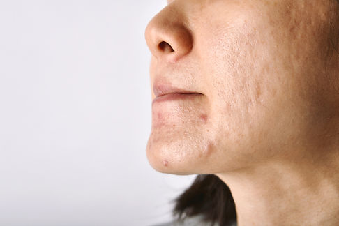 skin-problem-with-acne-diseases-2024-12-03-05-26-44-utc.jpg