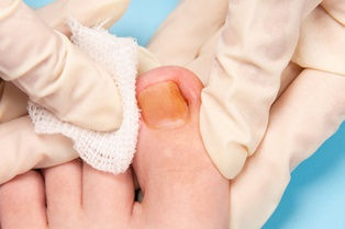 Chapter 3 – The problems of blood circulation in the diabetic foot