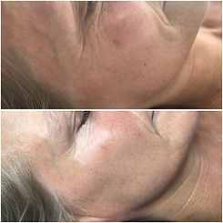 Dermalux Rejuvenation.jpeg