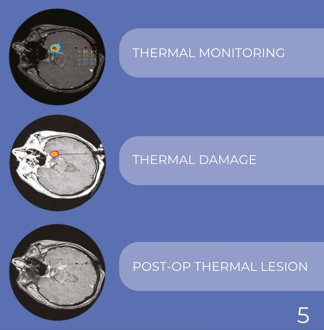 thermal monitoring and diode laser for brain tumor