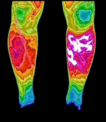 thermography legs blood clots vascular thermal scan