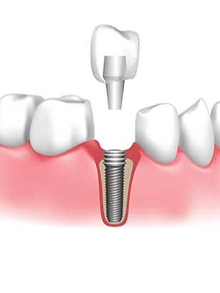 DENTAL IMPLANTS CDC_edited.png