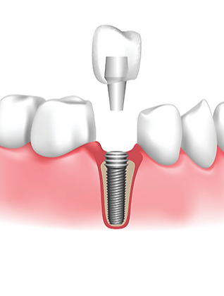 DENTAL IMPLANTS CDC_edited.png