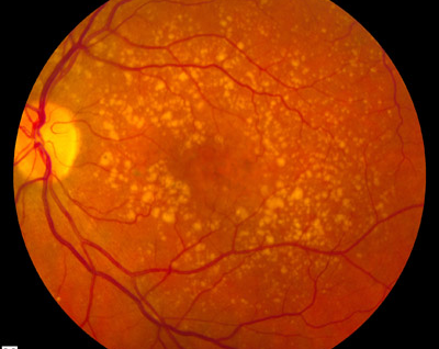 Macular Degeneration: How Five Millimeters Can Impact Your Life
