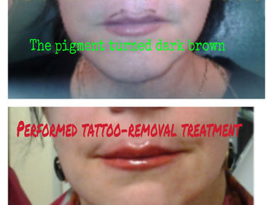 Correcting Undesireable Permanent Makeup in Lips!