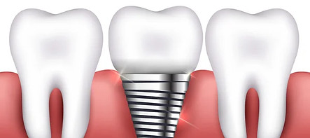 depositphotos_85784560-stock-illustration-dental-implant-and-normal-tooth.jpg
