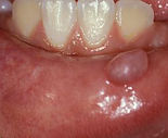 Mucocele