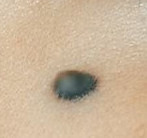 nevus azul