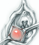Glándula bartolio inflamada