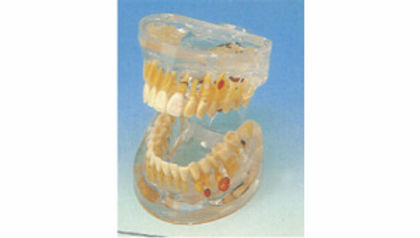 Transparent Dental Pathology Model