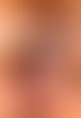 Acupuncture and Herb for Eyes Bleeding(Retinal, Vitreous or Fundus Hemorrhages)