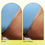 Thumbnail: Ingrown Concentrate