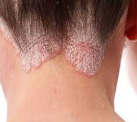 psoriase.jpeg
