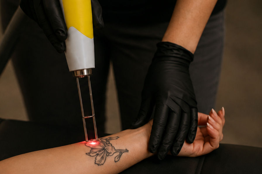 Mad_Ethels_Laser Tattoo Removal