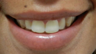 botox sorriso gengival