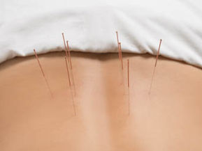 Relieve Sciatica Naturally with Acupuncture