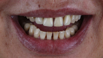 IMG_46Sorriso inicial. - Reabilitação Oral - Dr. Argemiro Souto00.JPG