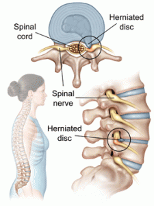 diagram of sciatic nerve