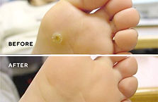 Wart or Veruca Removal