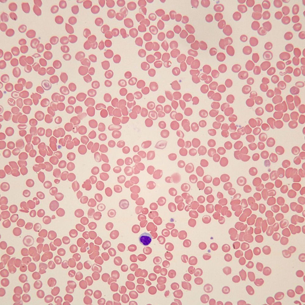 Human Sickle Cell Anemia Slide, Smear, Wright's Stain
