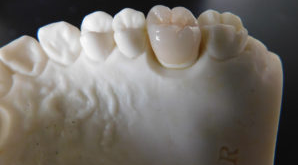 オールセラミッククラウン